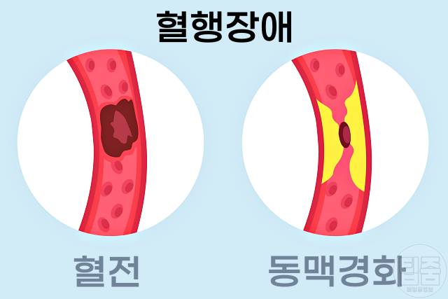 녹내장 원인 녹내장 실명확률 혈행장애