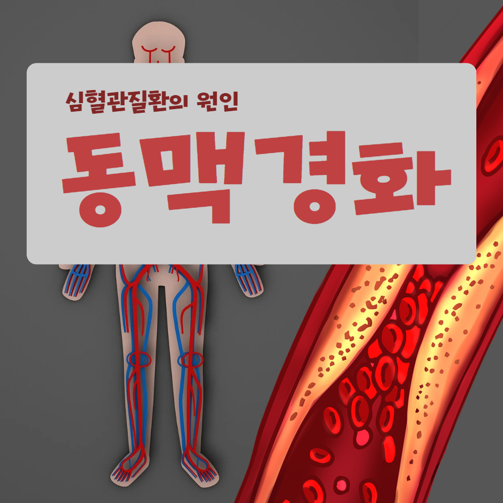 심혈관질환의 원인 동맥경화