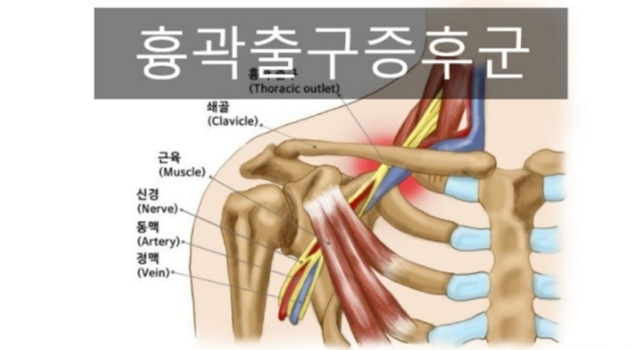 오른쪽 쇄골과 상완골, 그리고 갈비빼와 신경과 정맥, 동맥의 위치를 통해 흉곽출구 증후군이 발생되는 부위를 나타내주는 이미지 사진