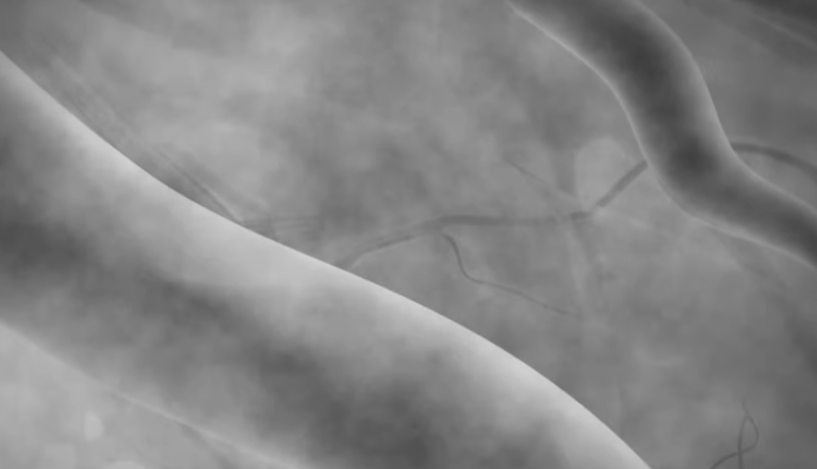 관상동맥 조영술