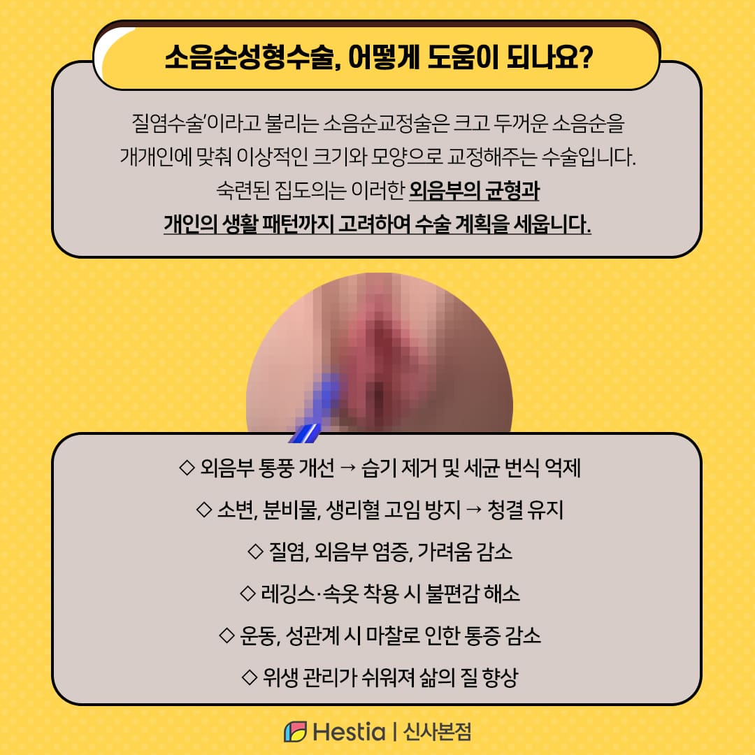 소음순성형수술, 어떻게 도움이 되나요?