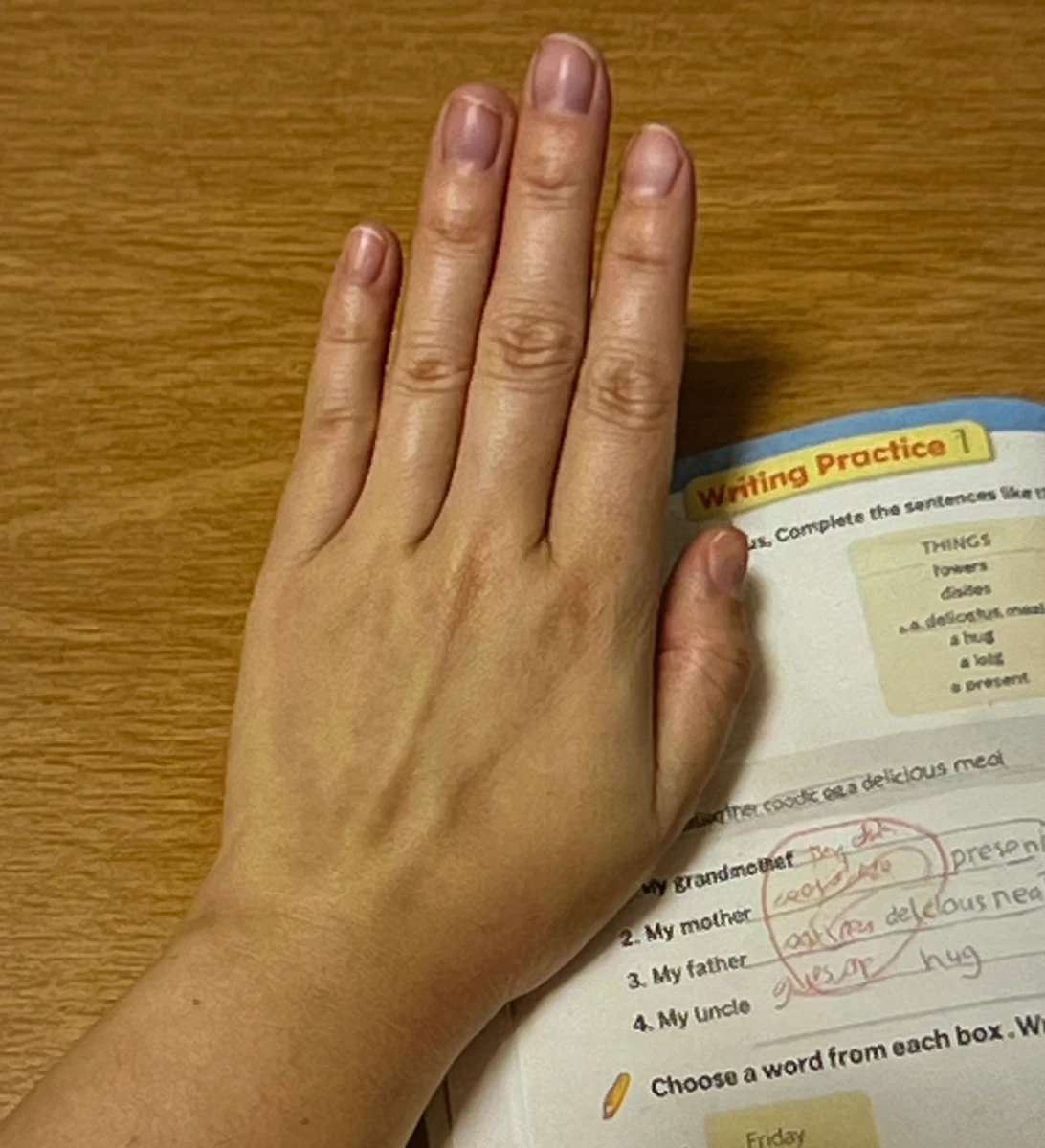 마이디데이-브로멜라인-내돈내산-후기-3개월차-손-모습