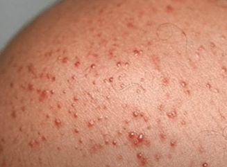 말라쎄지아(진균성 모낭염) 