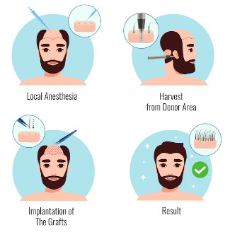 모발이식-절개-비절개-2