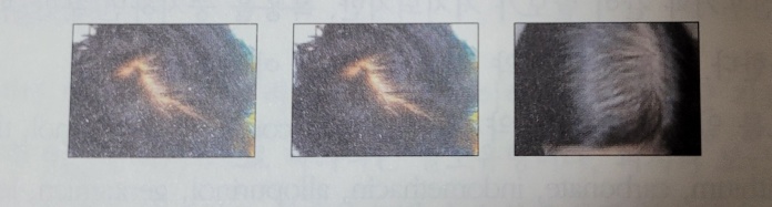 여성탈모증 이미지