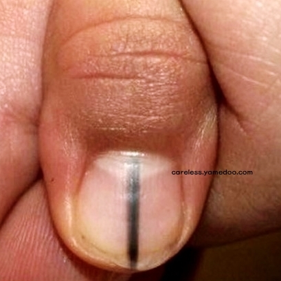손톱에 세로줄이 생기는 이유