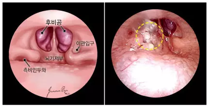 비인두 암