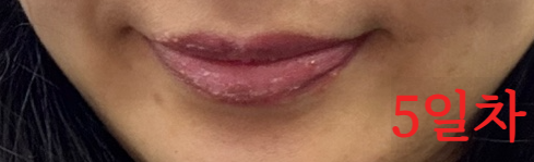 립타투 5일차 – 딱지 탈락 중, 입술 라인 건조함