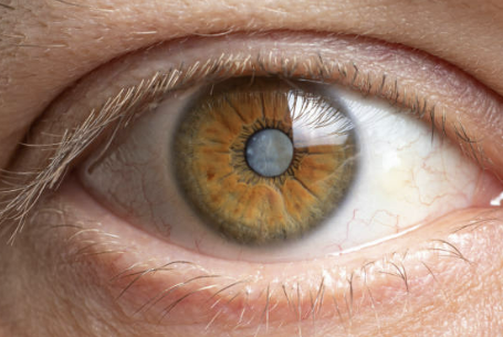 백내장 수술비용 초기증상 최저가 확인방법