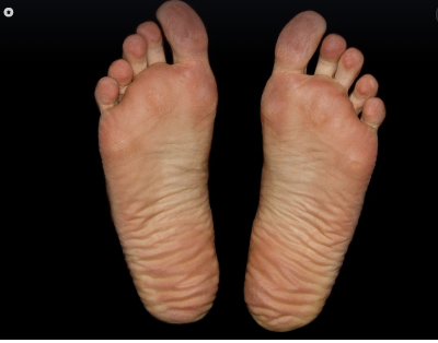 무지외반증 관련 사진