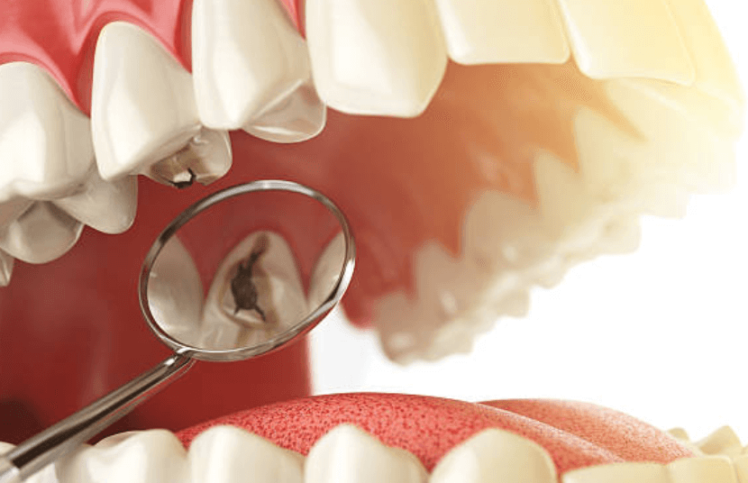 충치 치료 실비