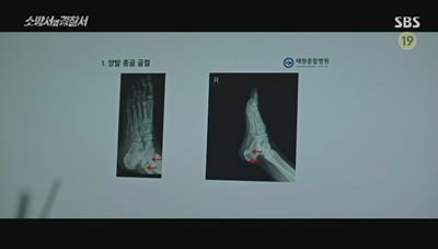 뼈에 골절이 여러군데 보이는 엑스레이 사진입니다.