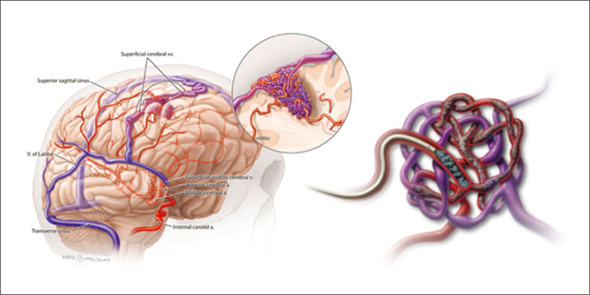 뇌 동정맥 기형 뇌출혈