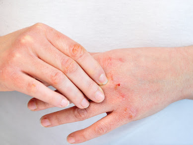 건선 완화하는 방법