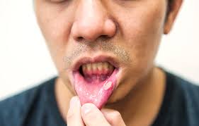 입안이 자주 허는 이유