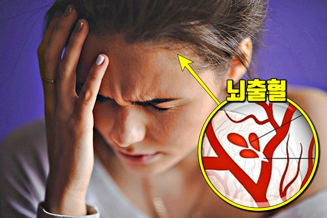 여성 뇌졸중 증상 원인, 건강 팁줌 매일꿀정보