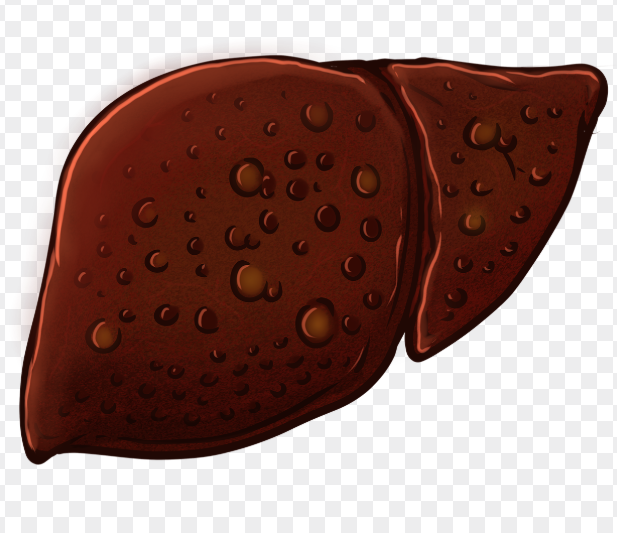 말기 간경화와 관련된 사진2