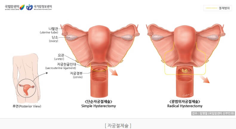 자궁경부암 수술방법
