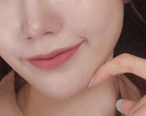 스킨보톡스 후기