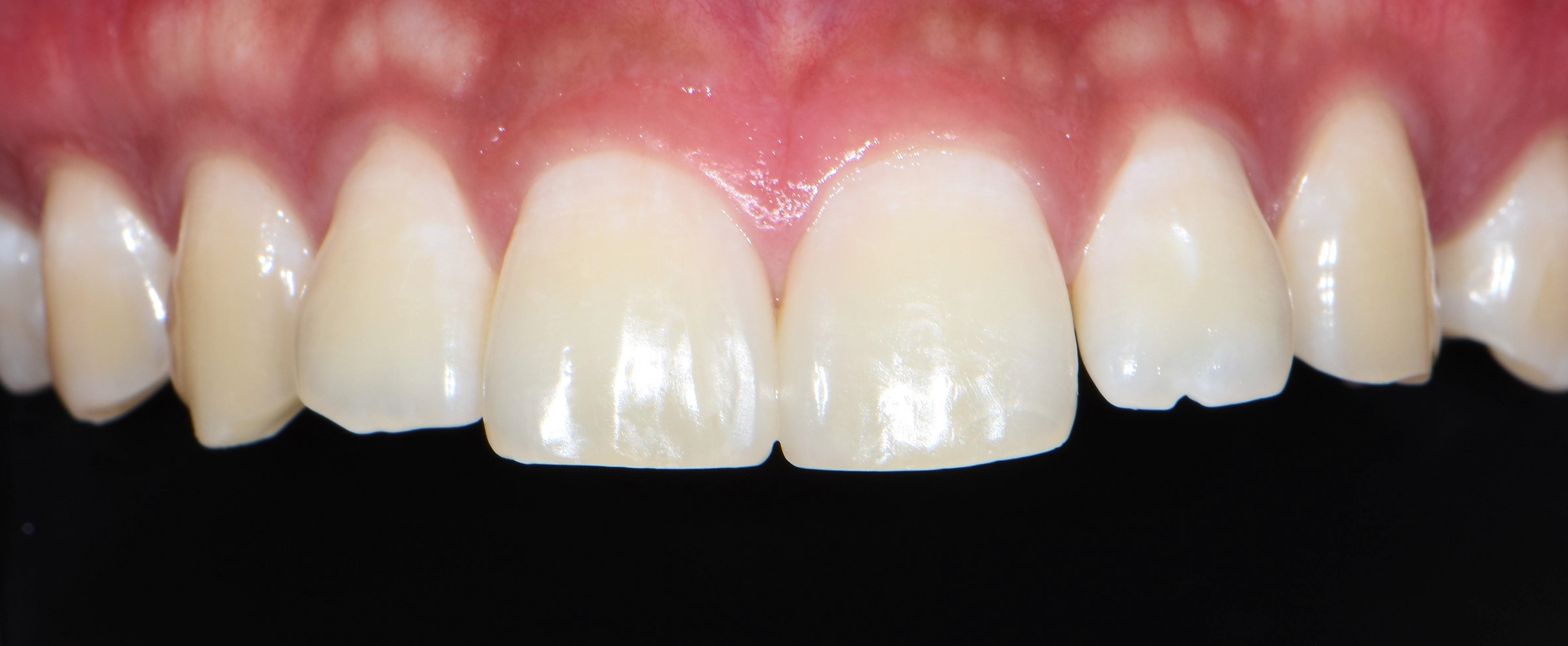 앞니 벌어짐 치아삭제없는 레진치료 후