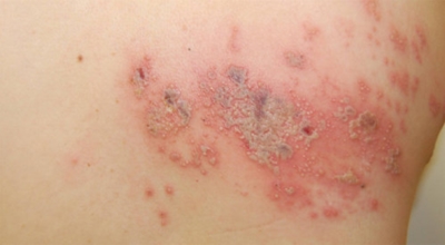 대상포진이미지