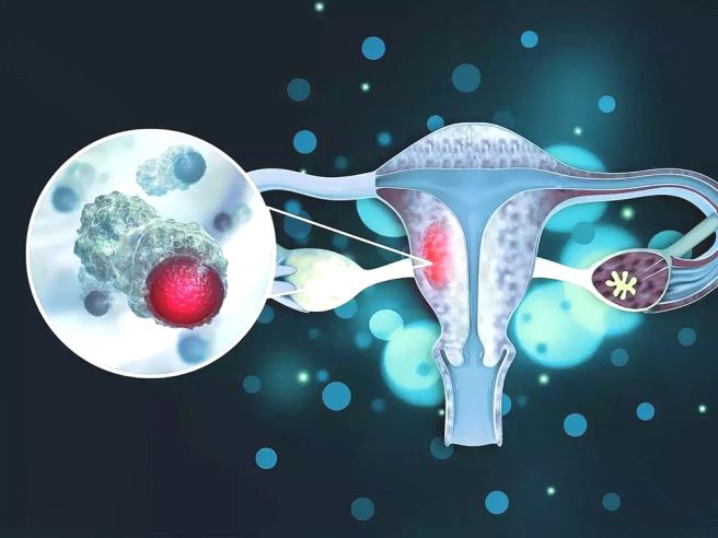 인유두종 바이러스 원인