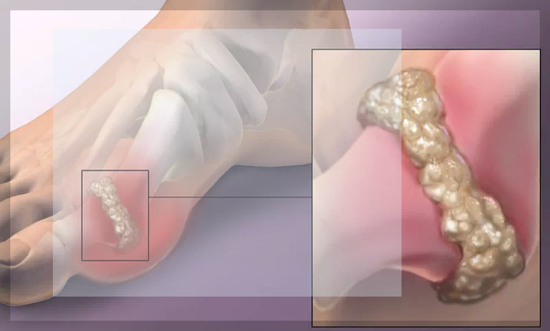 엄지발가락 통풍 관절염