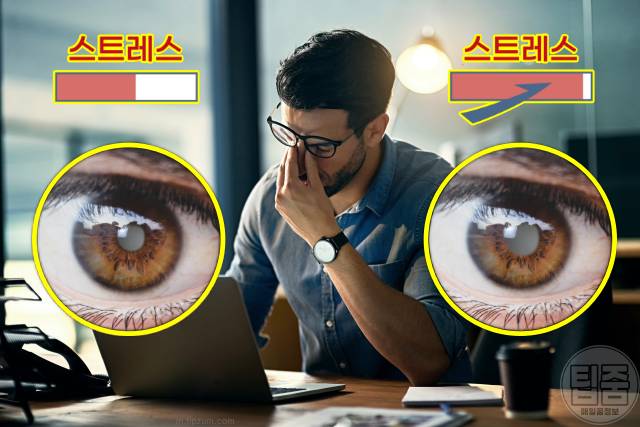 녹내장 원인 스트레스 녹내장 실명확률