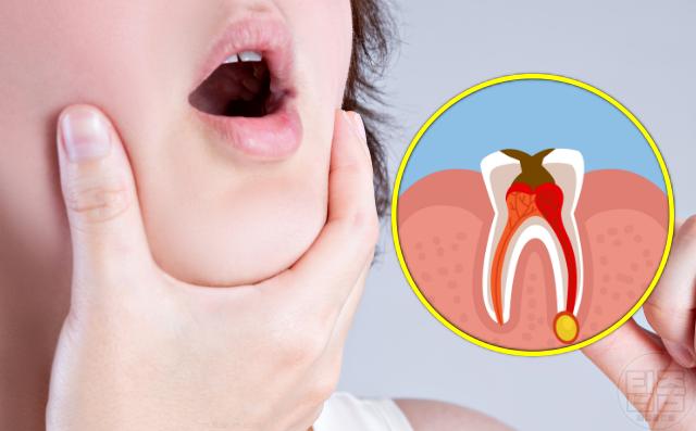 입냄새 심한 이유 입냄새 원인 질환 치아감염