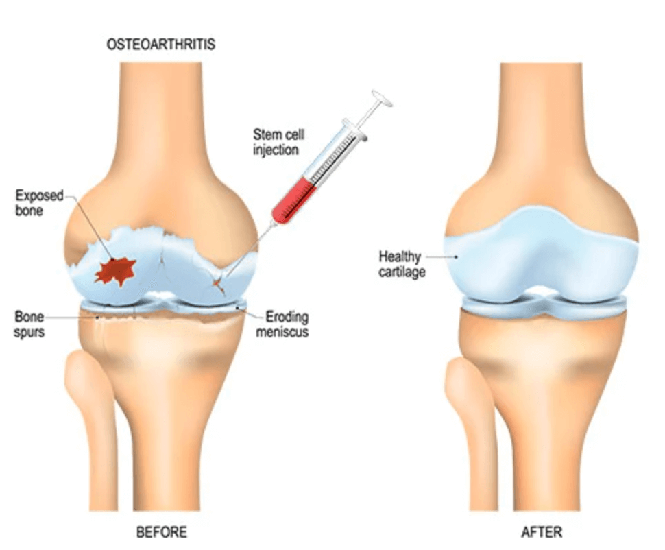 줄기세포 주사 치료