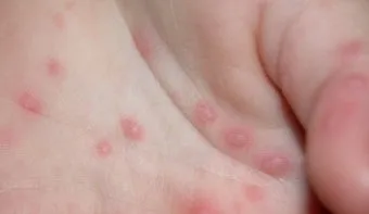 수족구 초기 증상 어른 감염 격리기간 예방 치료 완전 가이드_2