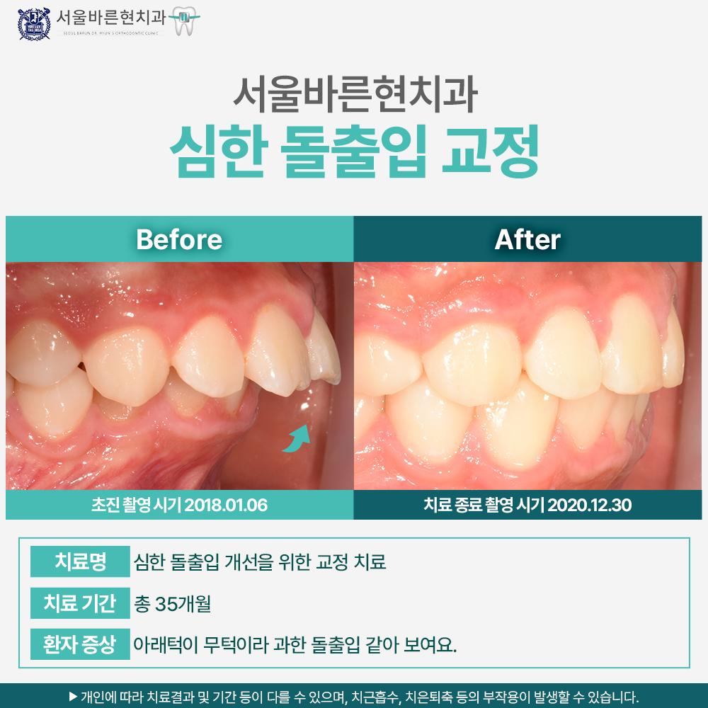 마린시티돌출입교정