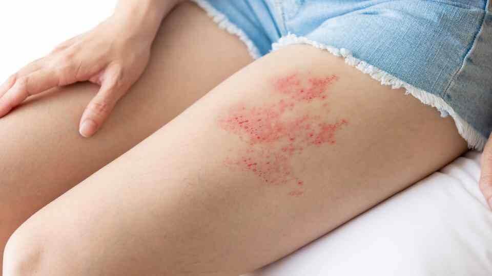 대상포진 초기증상