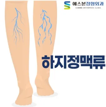 하지 정맥류 증상 치료방법과 예방 생활습관_13