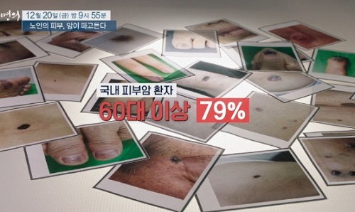 노인피부암-김훈수교수