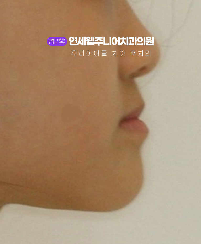 초등학생 주걱턱교정 전 아래턱이 돌출되어 보이는 아이 측면 모습