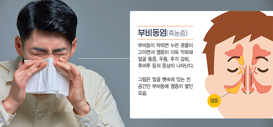축농증 개요
