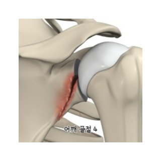 어깨통증원인