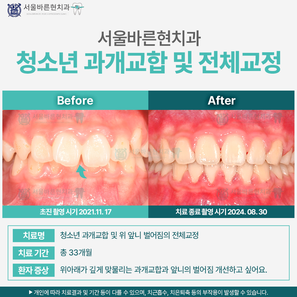 부산치아교정