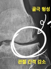 무릎관절염-골극-이미지