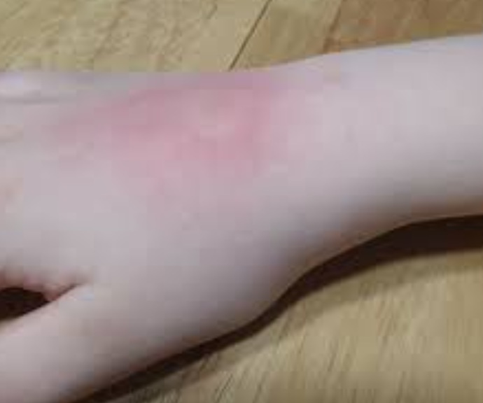 skeeter syndrome