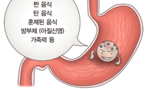 위암 이미지
