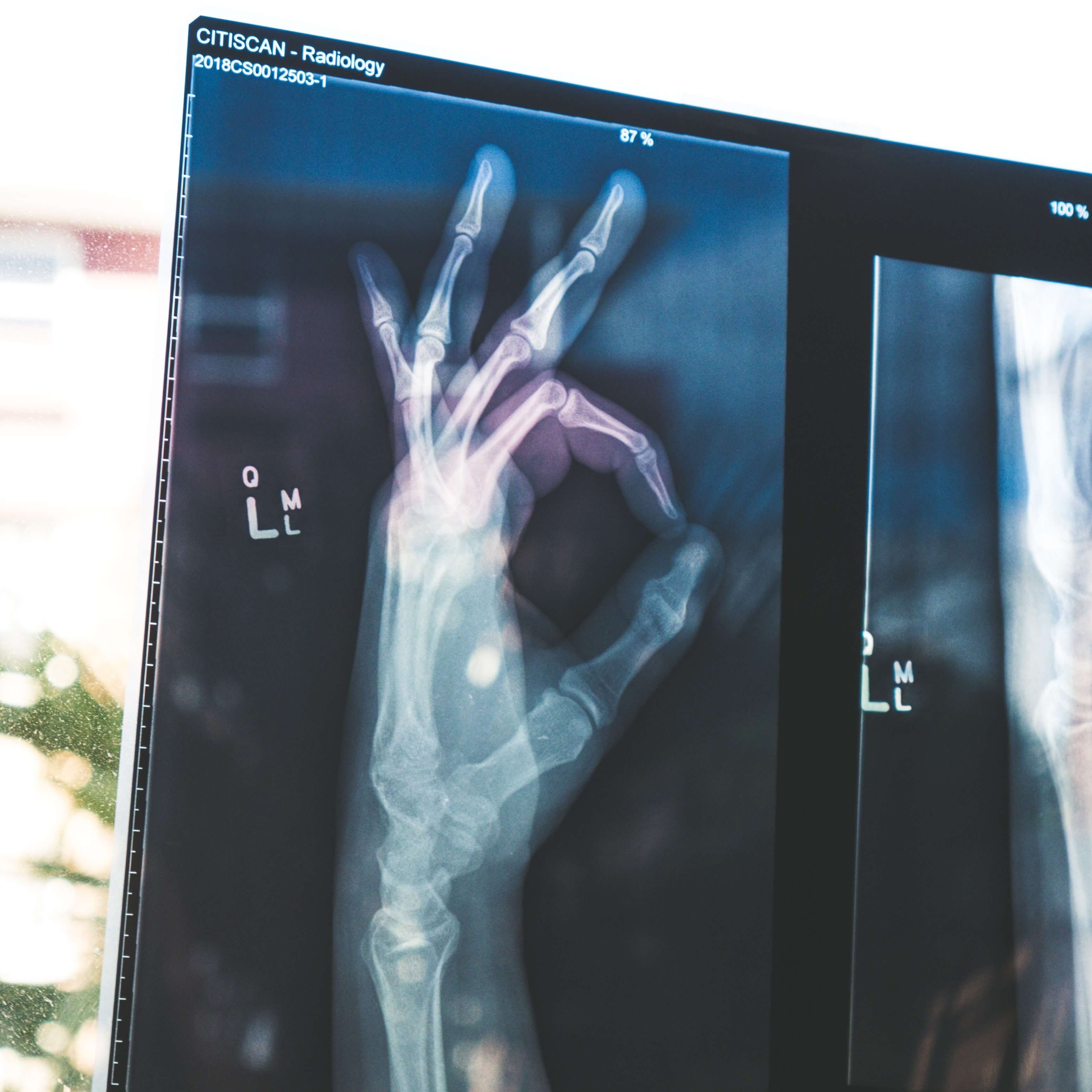 OK 표시를 하고 있는 손 뼈 사진 X-ray