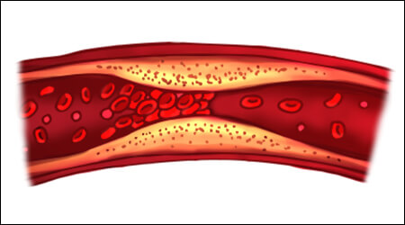 콜레스테롤로 혈관벽이 두꺼워진 모습
