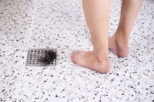 탈모증