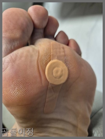 발바닥 티눈 치료법부터 재발 방지까지, 실제 후기로 정리한 팁