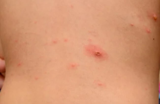 대상포진 초기증상 대상포진 조기치료 대상포진 초기증상 및 조기치료