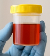 혈뇨가 나오는 이유