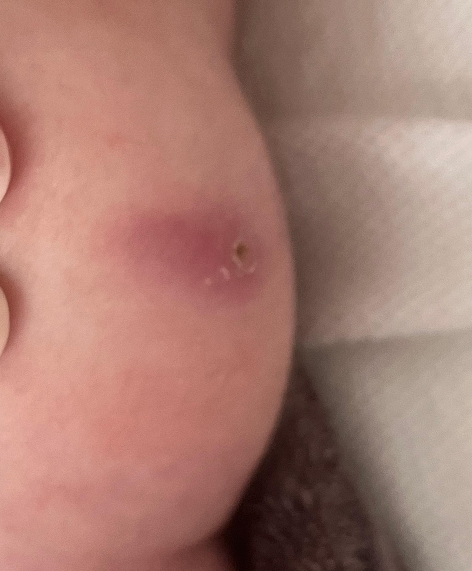 BCG 피내용 경피용