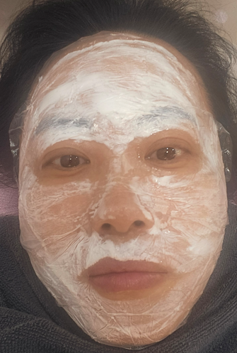 써마지 전 마취크림 도포